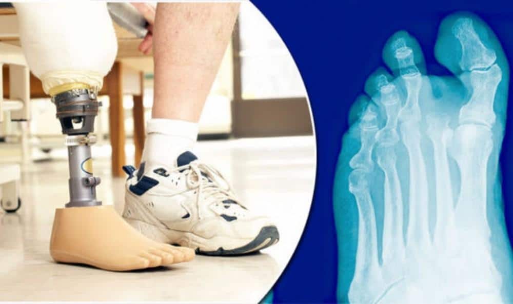 Regular vascular screening and atherectomy can help save limbs and prevent amputation