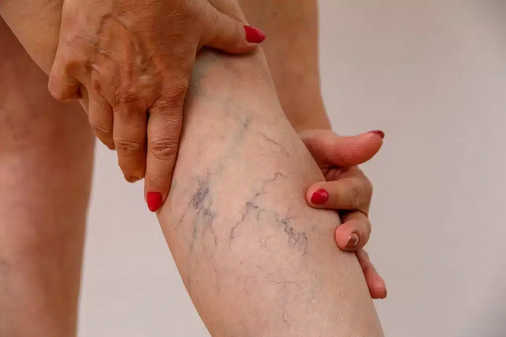 8spider veins
