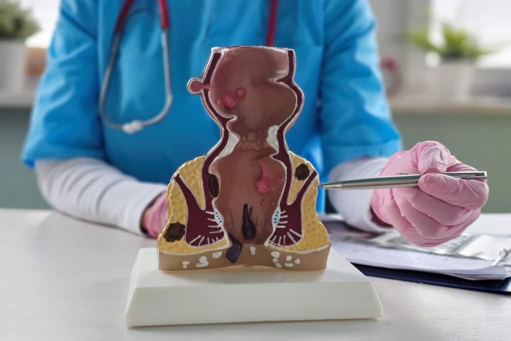 Rectal Bleeding or Hemorrhoid Symptoms Rectal Bleeding or Hemorrhoid Symptoms