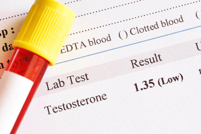 A lab test indicating that a man has low testosterone from an untreated varicocele A lab test indicating that a man has low testosterone from an untreated varicocele