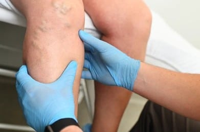 A close-up shot of a doctor examining varicose veins in a patient's legs