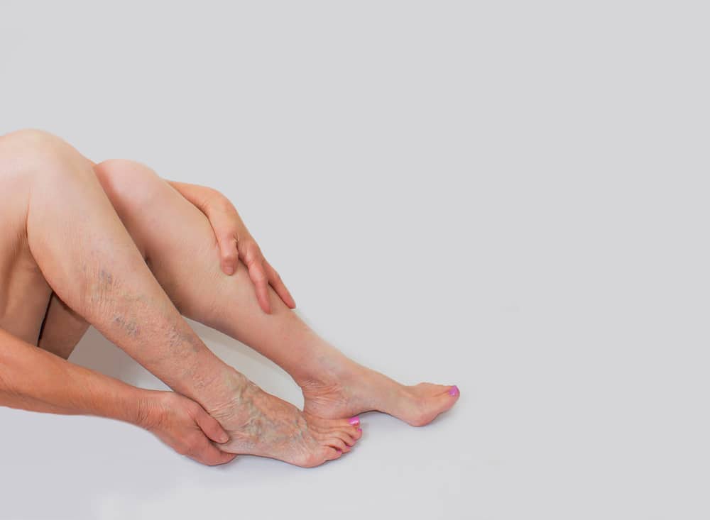 A woman with venous insufficiency and leg ulcers holding her legs a woman with venous insufficiency and leg ulcers holding her legs