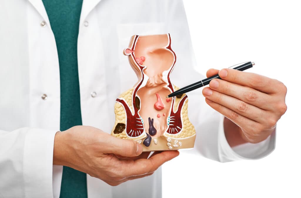 doctor holding a model and discussing hemorrhoid artery embolization in st. louis